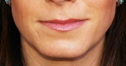 Lip Augmentation Before & After Patient #1194