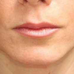 Lip Augmentation Before & After Patient #1194