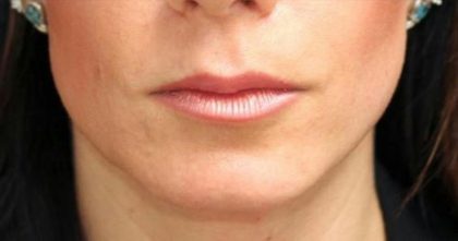 Lip Augmentation Before & After Patient #1194
