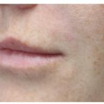 Lip Augmentation Before & After Patient #1191