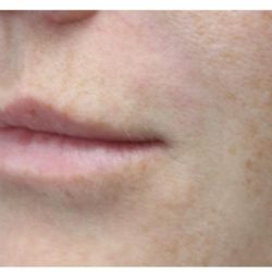 Lip Augmentation Before & After Patient #1191