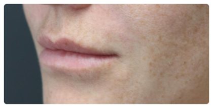 Lip Augmentation Before & After Patient #1191