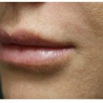 Lip Augmentation Before & After Patient #1191