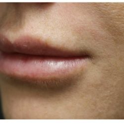 Lip Augmentation Before & After Patient #1191