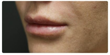Lip Augmentation Before & After Patient #1191