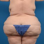 Liposuction Before & After Patient #1299