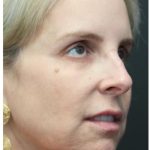 Liquid Facelift Before & After Patient #1326
