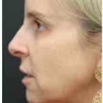 Liquid Facelift Before & After Patient #1326