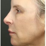 Liquid Facelift Before & After Patient #1326