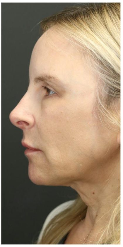 Liquid Facelift Before & After Patient #1326