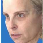 Liquid Facelift Before & After Patient #1326