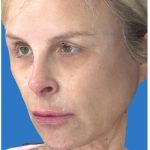 Liquid Facelift Before & After Patient #1326