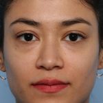 Liquid Rhinoplasty Before & After Patient #1329