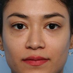 Liquid Rhinoplasty Before & After Patient #1329