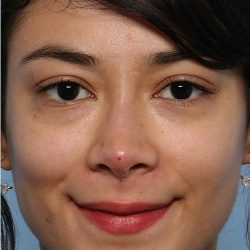 Liquid Rhinoplasty Before & After Patient #1329