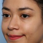 Liquid Rhinoplasty Before & After Patient #1329