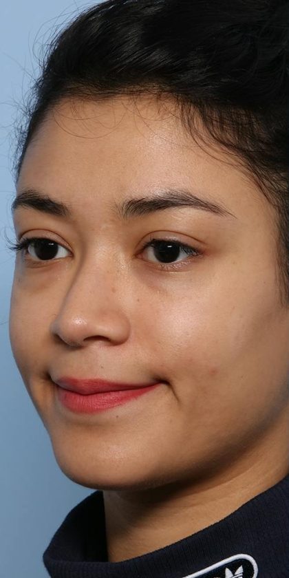 Liquid Rhinoplasty Before & After Patient #1329