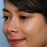 Liquid Rhinoplasty Before & After Patient #1329