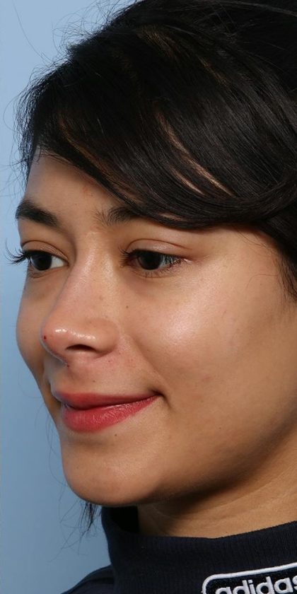 Liquid Rhinoplasty Before & After Patient #1329