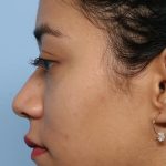 Liquid Rhinoplasty Before & After Patient #1329