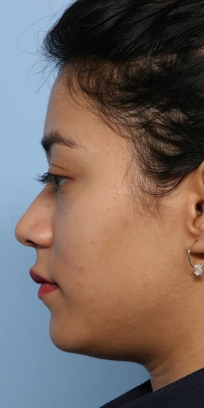 Liquid Rhinoplasty Before & After Patient #1329