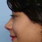 Liquid Rhinoplasty Before & After Patient #1329