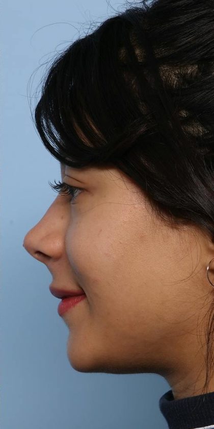 Liquid Rhinoplasty Before & After Patient #1329