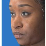 Liquid Rhinoplasty Before & After Patient #1328