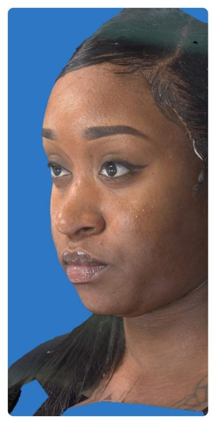 Liquid Rhinoplasty Before & After Patient #1328