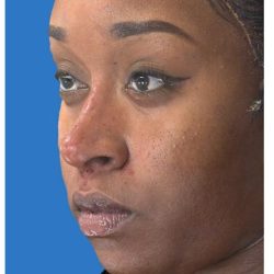 Liquid Rhinoplasty Before & After Patient #1328