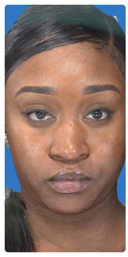 Liquid Rhinoplasty Before & After Patient #1328