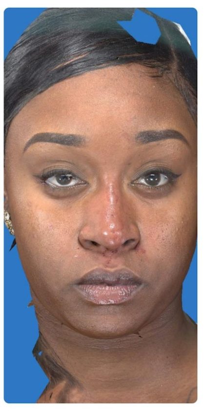 Liquid Rhinoplasty Before & After Patient #1328