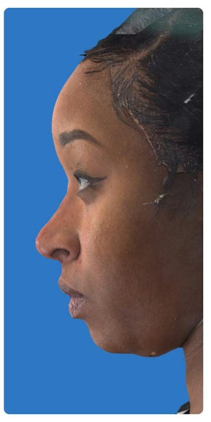 Liquid Rhinoplasty Before & After Patient #1328