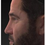 Liquid Rhinoplasty Before & After Patient #1327