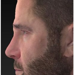 Liquid Rhinoplasty Before & After Patient #1327