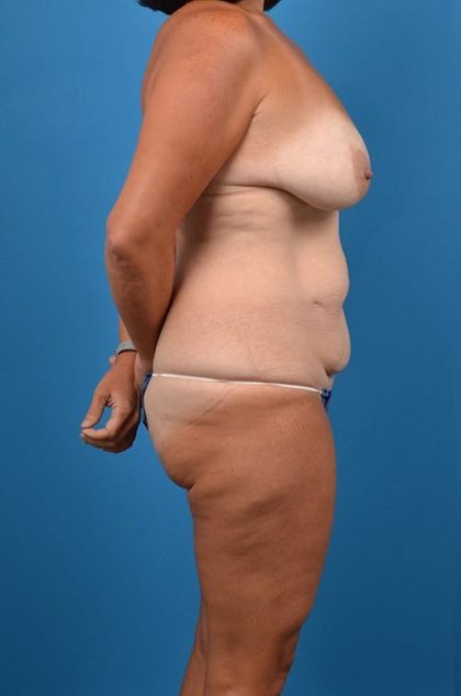 Mommy Makeover Before & After Patient #1300