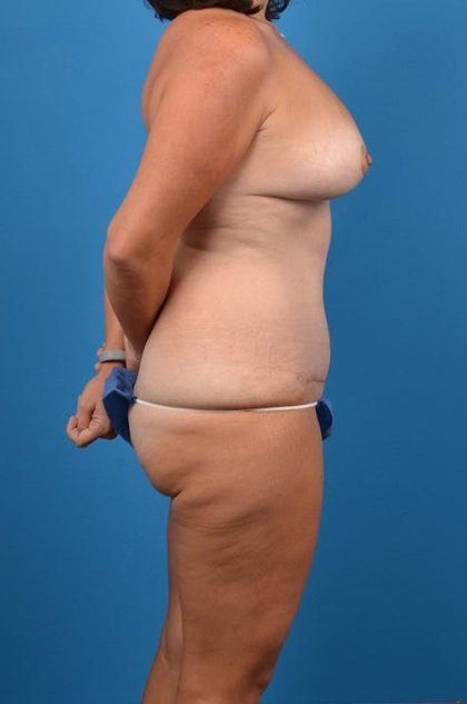 Mommy Makeover Before & After Patient #1300