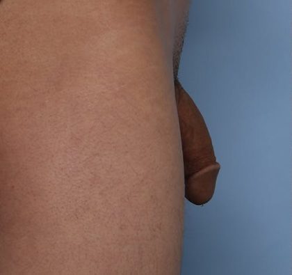 Non-Surgical Phalloplasty Before & After Patient #1311
