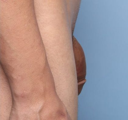 Non-Surgical Phalloplasty Before & After Patient #1311