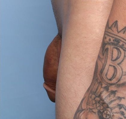 Non-Surgical Phalloplasty Before & After Patient #1311