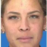 Photo Facial Before & After Patient #1211