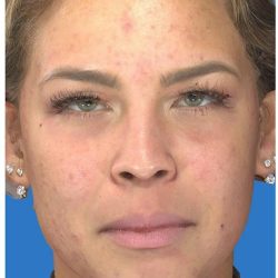 Photo Facial Before & After Patient #1211