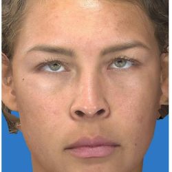 Photo Facial Before & After Patient #1211