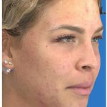 Photo Facial Before & After Patient #1211