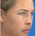 Photo Facial Before & After Patient #1211