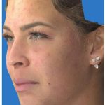 Photo Facial Before & After Patient #1211