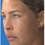 Photo Facial Before & After Patient #1211