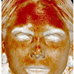 Photo Facial Before & After Patient #1210