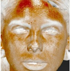 Photo Facial Before & After Patient #1210