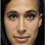 Photo Facial Before & After Patient #1209
